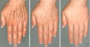 Peeling rukou